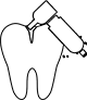 Root Canal Removal in Calgary On An Emergency Basis